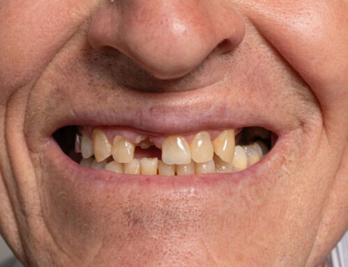 What Are My Options If I Lose a Tooth?