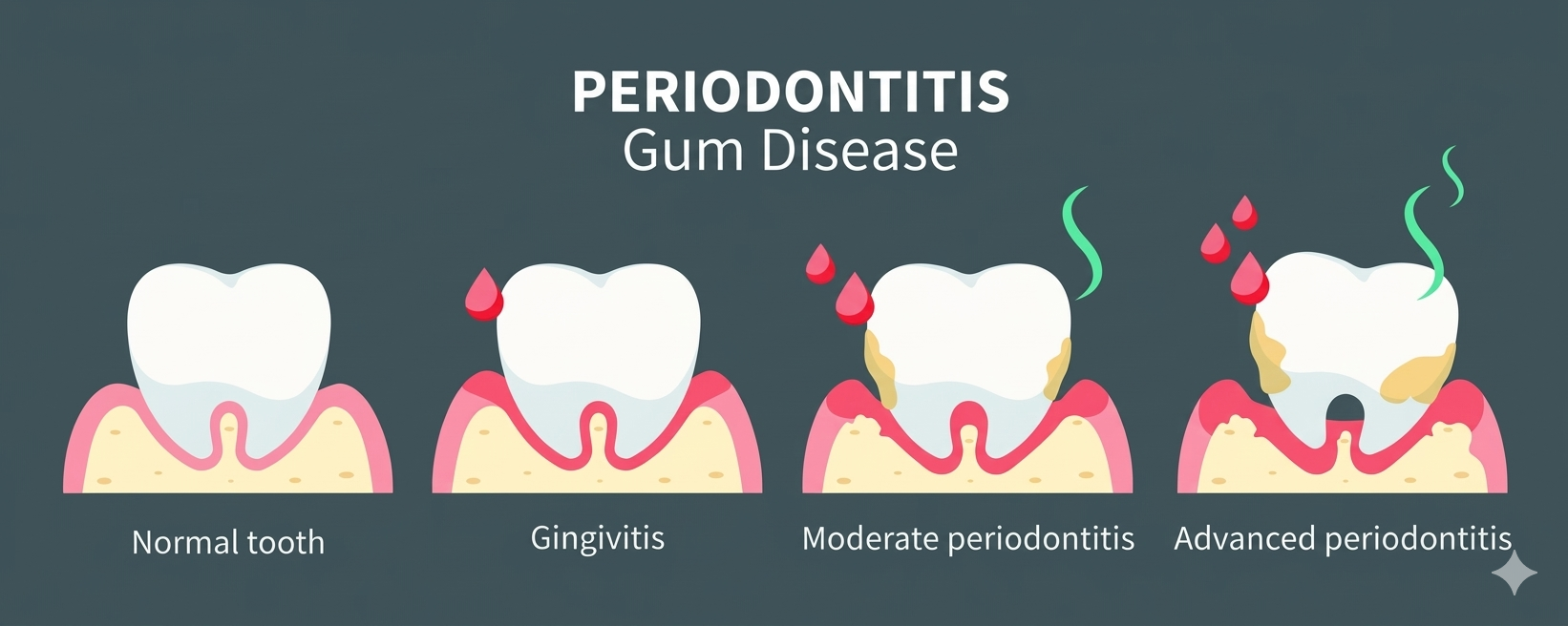 Illustration showing gum disease progression: normal tooth, gingivitis with red gums, moderate periodontitis with receding gums and bone loss, and advanced periodontitis with damaged bone and pus—highlighting the importance of regular dental cleaning.